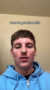 How to have clear skin! #acne #skincare #skincareroutine  #creatorsearchinsights