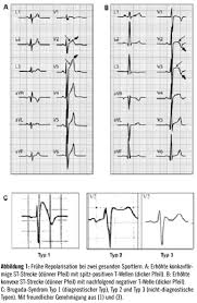 Bleibt sie akut, lässt sie sich noch gut behandeln. Das Sportler Ekg Aktuelle Interpretationen Und Empfehlungen