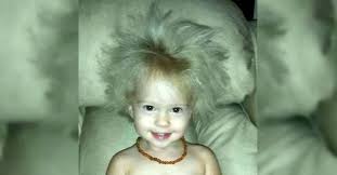 Causes, natural treatment, and prevention tips. Baby With Crazy Hair Has Same Gene Disorder As Einstein Littlethings Com