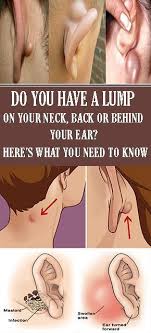 Do You Have A Lump On Your Neck Back Or Behind Your Ear Here S What You Need To Know Epidermoid Cyst Lump Behind Ear Neck