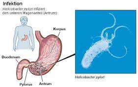 Nobelpreis 2005 Magenkeim Helicobacter Pylori Durch Widerspruch Zum Erfolg