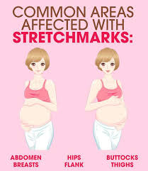 You need to strengthen your lower back to fix your slouched posture, and shoulders to fix hunched shoulders. How To Get Rid Of Stretch Marks With Natural Home Remedies Femina In