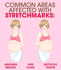 how to get rid of stretch marks with
