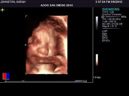 Without being exposed to radiation, an ultrasound is the safest procedure for both mother and baby throughout the course of a pregnancy. Matt Sarah Matt Sarah Page 4