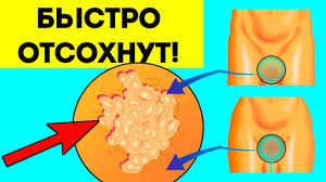 как избавиться от бородавок под мышками в домашних условиях Papillomy Otpadut Bystro Samyj Prostoj Sposob Udaleniya Visyachih Rodinok V Domashnih Usloviyah Dyoshevo Youtube