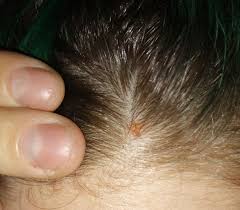 If any fluid is oozing from your scalp, it's essential that you determine the I Have Scabs Like These On My Scalp Irl It S Red As Well As This Really Chunky And Often Bloody Dandruff I Am Going To The Doctor Soon But What Are Some