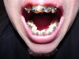 It is important to wear your retainer because as your body grows, your teeth do some shifting. How Long Do You Have To Wear Braces Arxiusarquitectura