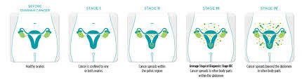 Types Stages National Ovarian Cancer Coalition