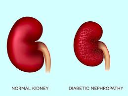 Image result for images Diabetic nephropathy