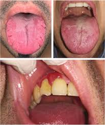 Image result for Fissured tongue