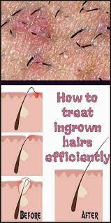 Ingrown pubic hairs are usually single bumps, while genital herpes is typically a cluster of sores or lesions. Pin On Consejos