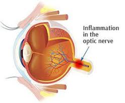 10 amazing home remedies for neuropathy. Home Remedies For Optic Neuritis Natural Treatment