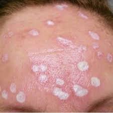 Some medications and home remedies may answer questions. Pdf 70 Trichloroacetic Acid In The Treatment Of Facial Sebaceous Hyperplasia