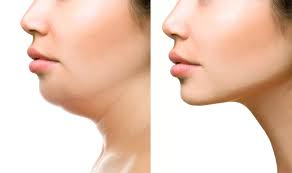 Double Chin Treatment: Double Chin Removal in Dubai, Abu Dhabi
