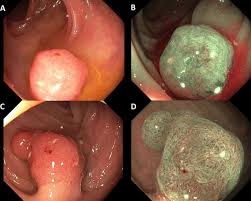 Image result for Colon Cancer Screening with Colonoscopy