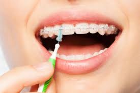 Permanent retainers are great appliances that can help you keep your teeth nice and straight after you get your braces removed. Tips For Flossing With Braces Know How These Tips May Help You