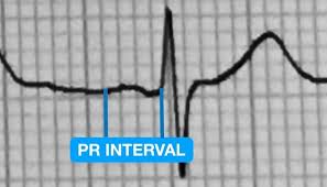 Image result for PR Interval