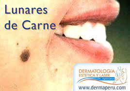 Lunares De Carne Tratamientos Y Consideraciones Dermaperu