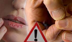 Subungual or nail bed melanoma is a type of cancer that affects the nail bed, it begins in the nail matrix. Skin Cancer Symptoms Chapped Lips And A Bruised Nail Are Warning Signs Of The Disease Express Co Uk