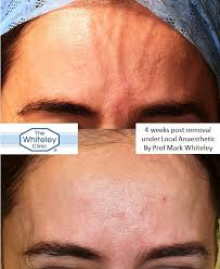 Some of the other symptoms which may accompany forehead skin abscess are: Forehead Veins Before And After Removal The Whiteley Clinic