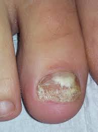 My wife had toenail fungus for many years before she discovered how to treat it successfully using natural what is toenail fungus and how do you treat it? Most Effective Laser Nail Fungus Treatment Nail Fungus Cure Denver