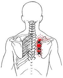 The Rhomboid Major And Minor Are Located Between The Shoulder Blades And Spinal Column They Re Prime Movers In Scapul Trigger Points Muscle Knots Dry Needling