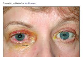 Image result for Mydriasis