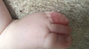 How to remove hair during pregnancy safely. Tourniquet Syndrome Nearly Cost My Baby Two Of Her Toes Bbc News