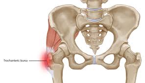 This can cause a runner to. Greater Trochanteric Bursitis A Common Cause Of Hip Pain The Leone Center For Orthopedic Care