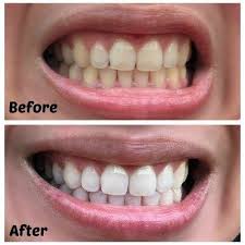 Teeth whitening strips should be applied to the teeth on a daily basis. 19 Teeth Whiteners That Work So Well It S Basically Magic