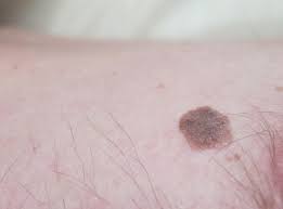 We did not find results for: Penyingkiran Laser Pada Neoplasma Kulit Pertumbuhan Papilloma Harga Prosedur Ulasan Bagaimana Kelanjutannya