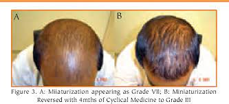 It is characterized by an abrupt onset of hair shedding usually seen several months after a triggering event. Cyclical Medicine For Hair Loss Management And Improved Results In Hair Transplantation Semantic Scholar