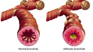 Image result for Inhalation Challenge Test