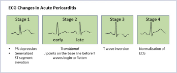 In both cases, the body's immune system causes inflammation in response to an infection or some other trigger. Cups To Manage Pericarditis The Journal For Nurse Practitioners