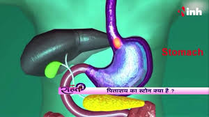 Gallbladder Stone Treatment In Hindi Home Remedies For Gallbladde Stones Without Surgery Youtube