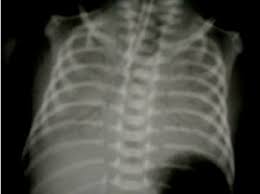 Image result for Air Bronchogram