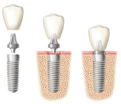 Dental Implants Archives Bayou Dental Group