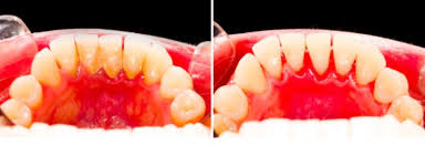 Brushing and flossing often prevent plaque and tartar from forming. 7 Effective Ways To Remove Dental Plaque At Home