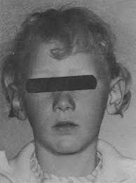 Oligodontia, Taurodontia, and Sparse Hair Growthâ•ﬂA Syndrome