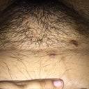 It may often be mistaken for pimples, genital warts or genital. I Have Extreme Ingrown Hairs On My Pubic Area Would Laser Treatment Be Best Photos