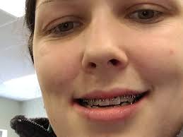 Fundraiser by Samantha Sprinkle : Help Sam Pay for Jaw Surgery BSSO