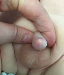 Image result for Phimosis