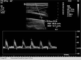 Common Carotid Artery End Diastolic Velocity And