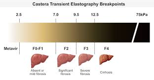 My Husband Beat Cirrhosis My Husbands Fibroscan Results