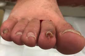 Image result for Koilonychia feet