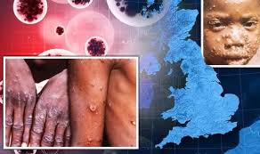 Monkeypox was first identified in laboratory monkeys in 1958. Monkeypox Case Of Rare Virus Confirmed In Uk Signs And Symptoms Express Co Uk