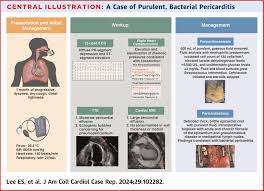 Image result for Pericarditis