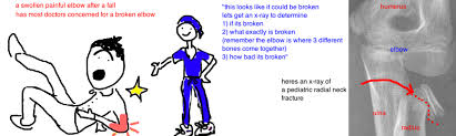 It depends on which bone, or part of you elbow. Kids Radial Neck Fracture Bone Talks
