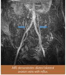 Healthy Viewpoints Pelvic Congestion Syndrome