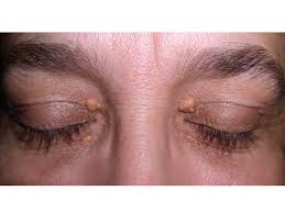 Image result for xantelasma
